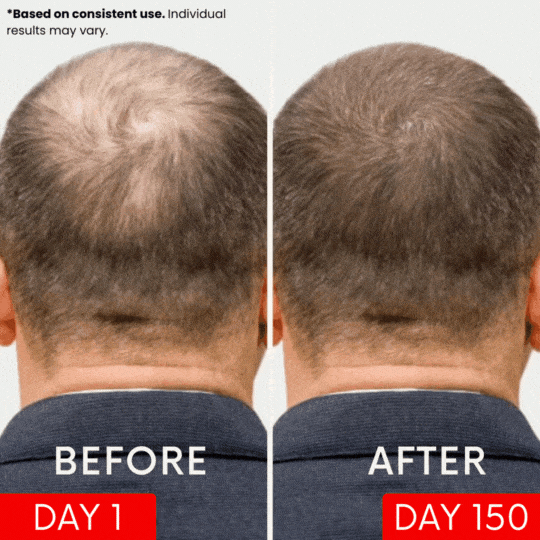 APE BORN Red Light Therapy Hat